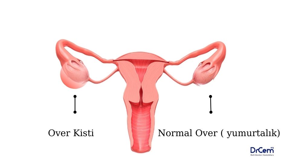 Over Kisti görseli - DrCem hastalık rehberi
